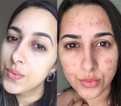 Trío Poderoso THE ORDINARY: Niacinamida + Ácido Hialurónico + Salicílico