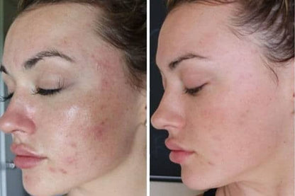 Trío Poderoso THE ORDINARY: Niacinamida + Ácido Hialurónico + Salicílico