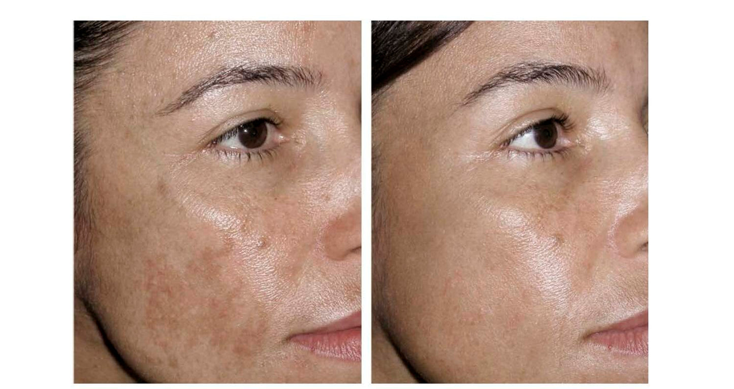 Trío Poderoso THE ORDINARY: Niacinamida + Ácido Hialurónico + Salicílico