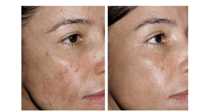 Trío Poderoso THE ORDINARY: Niacinamida + Ácido Hialurónico + Salicílico